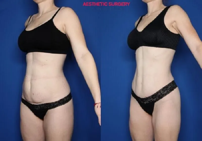 The client’s waistline after abdominoplasty at Aesthetic Surgery Center is firmer, slimmer, and more sculpted.