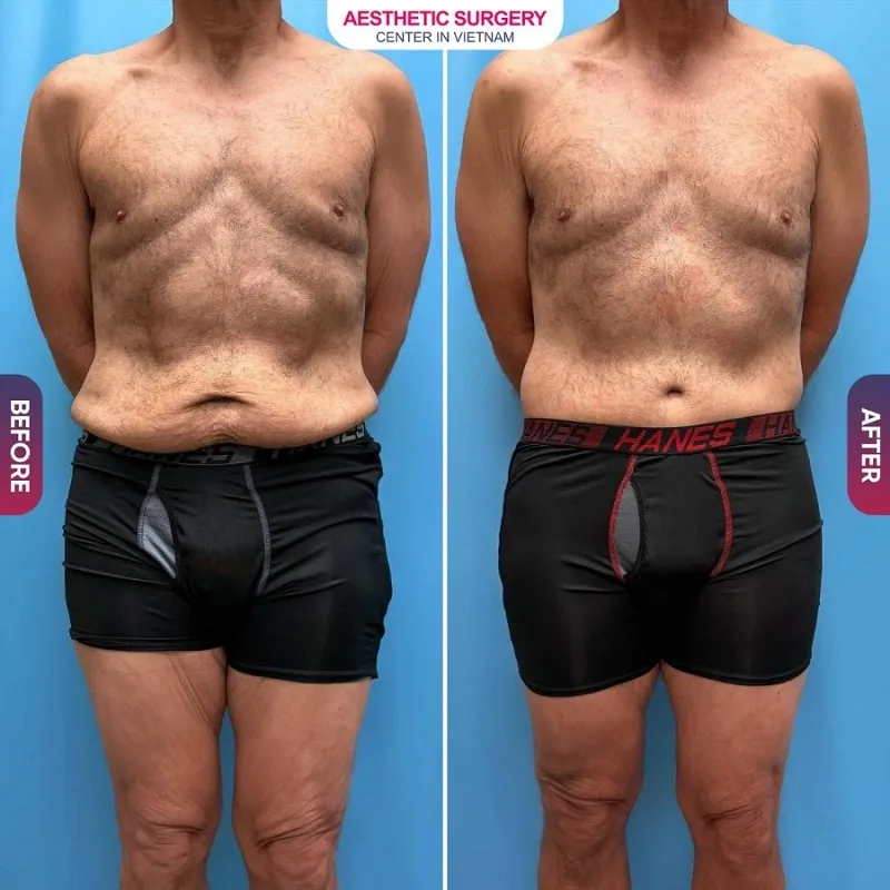 The abdominal area had excess fat removed, resulting in a firm, sculpted waistline with natural-looking muscle definition for the client.