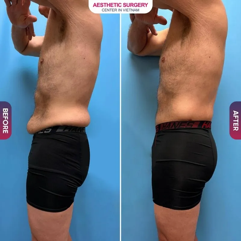 The male client’s abdominal area after abdominoplasty is not only firm but also features defined abs, meeting his desired outcome.