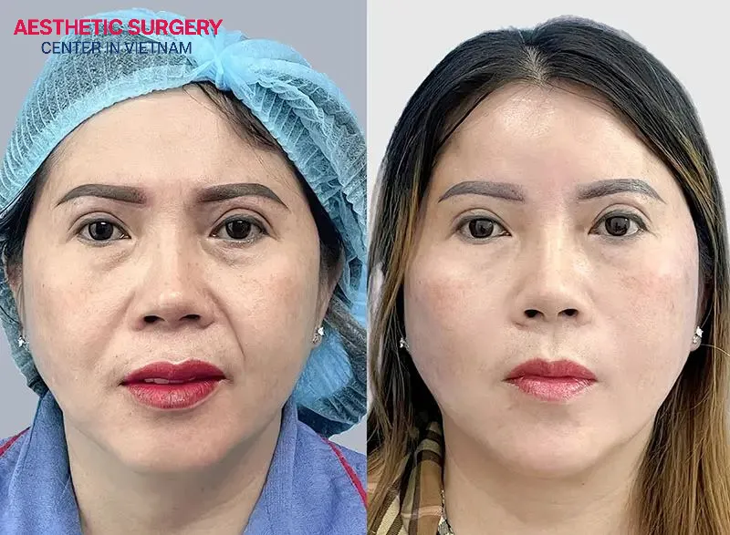What is the right age for a Facelift?