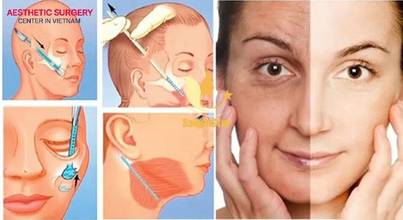 What is the suitable age for a Facelift? Individuals aged 40–50 are most suitable for a full Facelift or endoscopic Facelift.