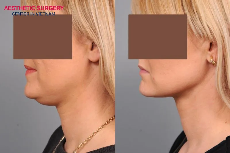 If chin liposuction goes wrong, it should be addressed promptly to restore a naturally attractive chin shape.