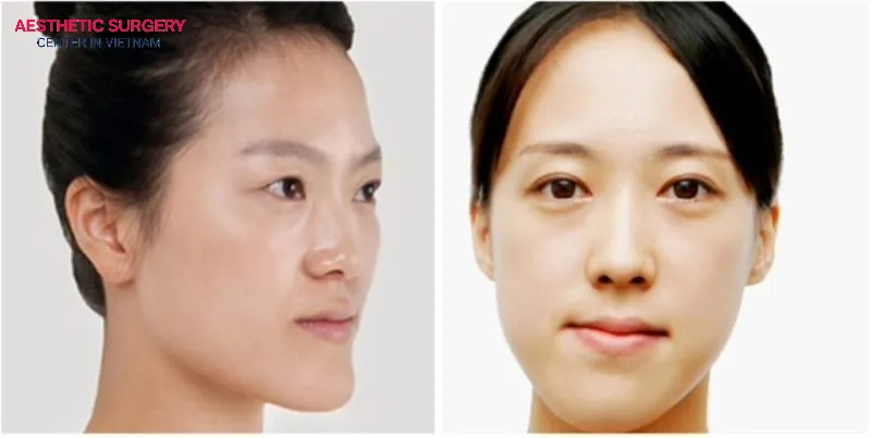 A botched chin liposuction can result in an uneven chin, making the face appear asymmetrical and less aesthetically pleasing.