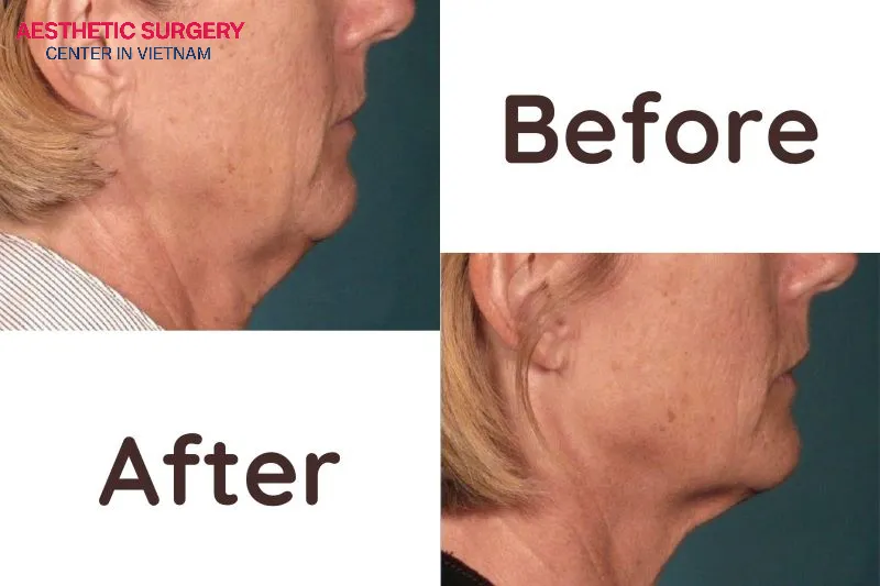 Loose skin not only makes the face look older but also reduces the desired slimming effect.