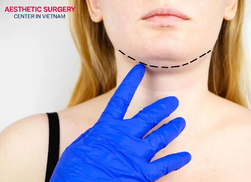 Unusually firm fat tissue may be a sign of chin liposuction gone wrong, and you should promptly consult a specialist.