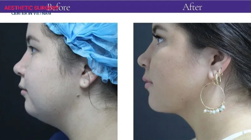 A skilled surgeon not only delivers natural-looking aesthetic results but also helps minimize the risk of scarring.