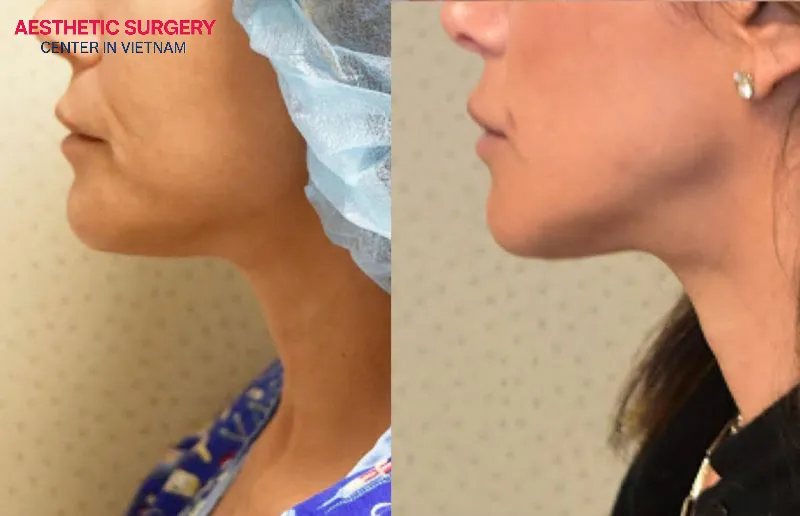 After chin liposuction, patients need to maintain a stable weight to ensure long-lasting results.