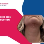 botched chin liposuction