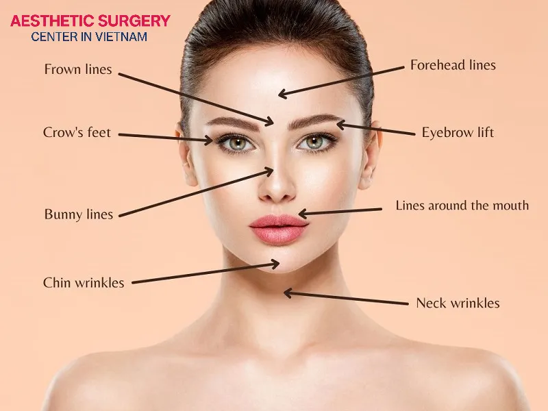 Botox can be injected into various areas of the body, such as the forehead, eyebrows, cheeks, lips, chin, and more.