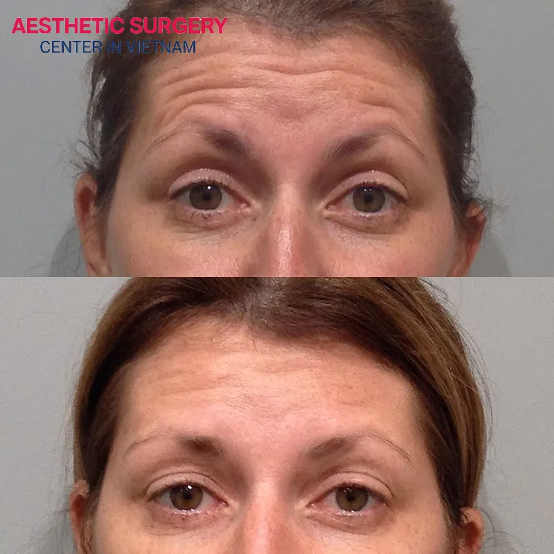 Botox for wrinkles injections help soften wrinkles, giving users a more youthful and refreshed appearance.