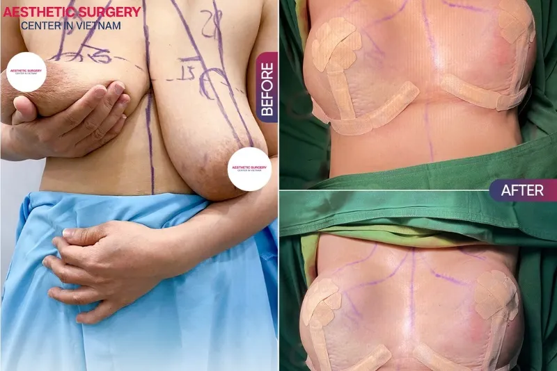 Breast lift surgery at Aesthetic Surgery Center effectively corrects sagging, loose, and shapeless breasts.