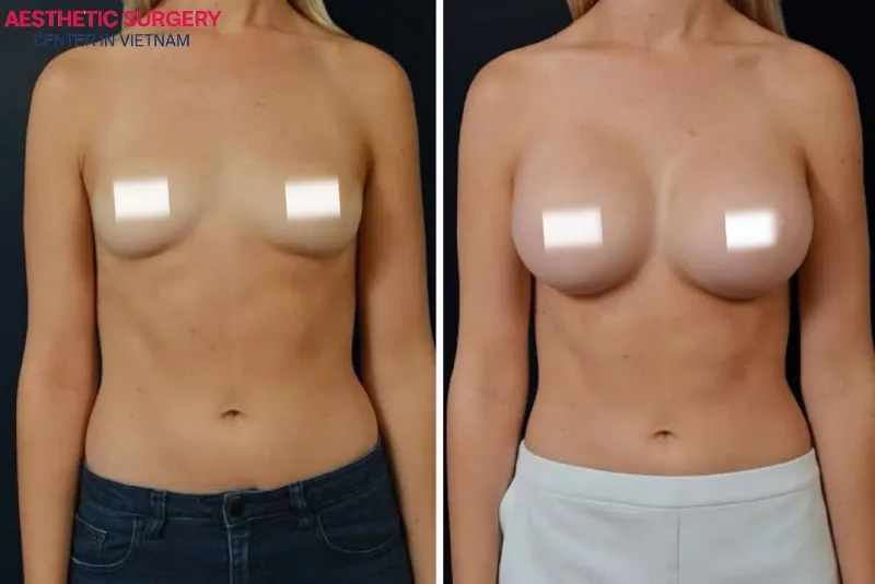 Before-and-after images of clients after breast lift at Aesthetic Surgery Center.