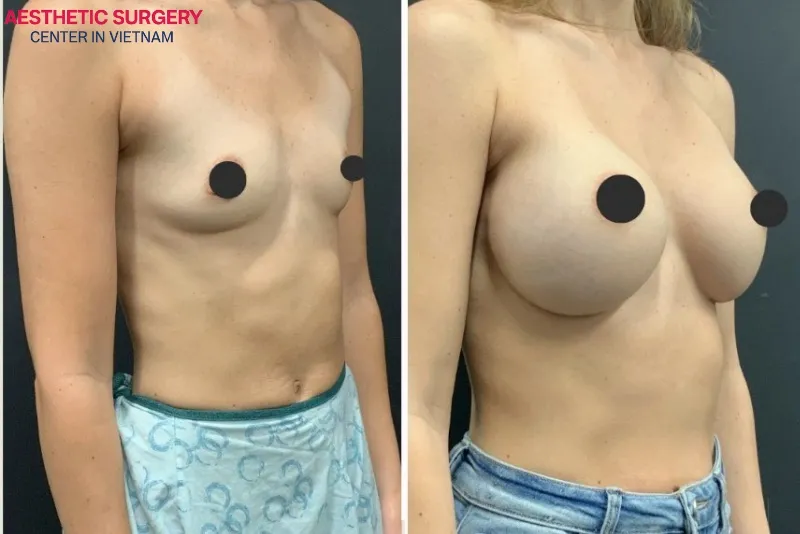 The noticeable transformation of clients’ breasts after breast lift at Aesthetic Surgery Center in Vietnam.