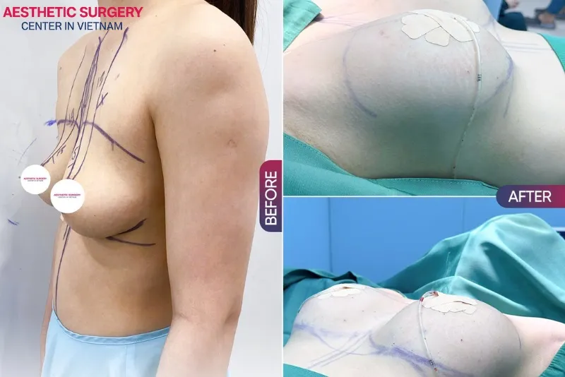 The client achieved a full and firm bust after undergoing a breast lift at Aesthetic Surgery Center.