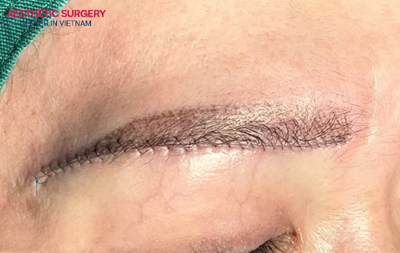 Brow lift is an aesthetic method that helps reposition the eyebrow's location to the correct standard facial proportion.