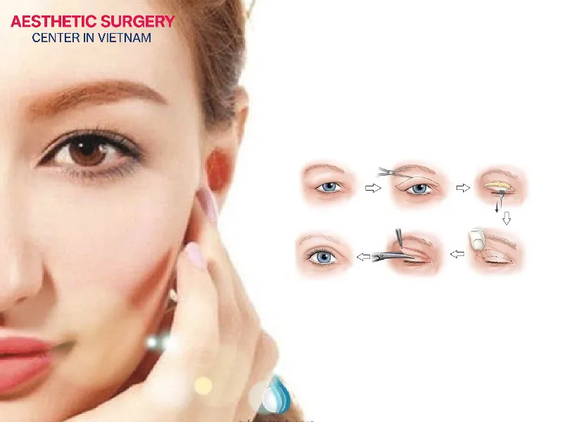 Blepharoplasty is a method to reshape a new eyelid crease by removing excess fat, loose skin, creating a connection between the levator muscle and eyelid skin.
