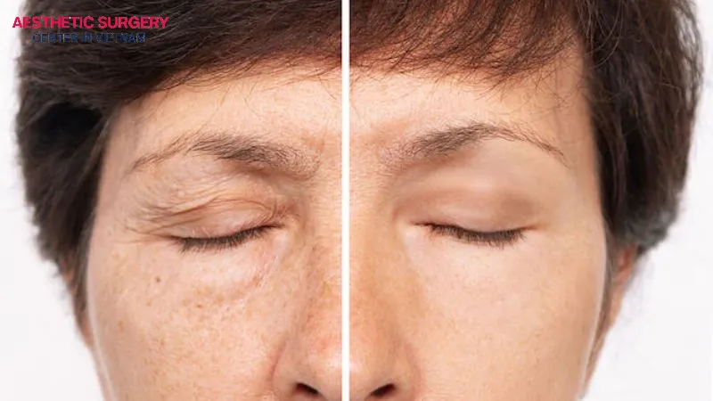 It is possible to combine brow lift and blepharoplasty to resolve signs of aging.