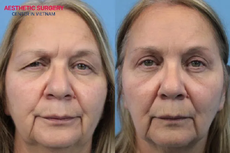 Aging in the eyelid and brow area has been resolved after performing blepharoplasty with brow lift surgery.