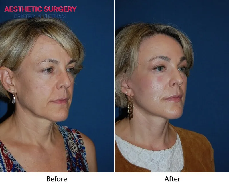 Images of blepharoplasty with brow lift surgery before and after, clearly showing the change in the lady's appearance.