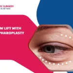brow lift with blepharoplasty