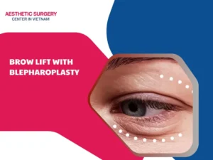 brow lift with blepharoplasty