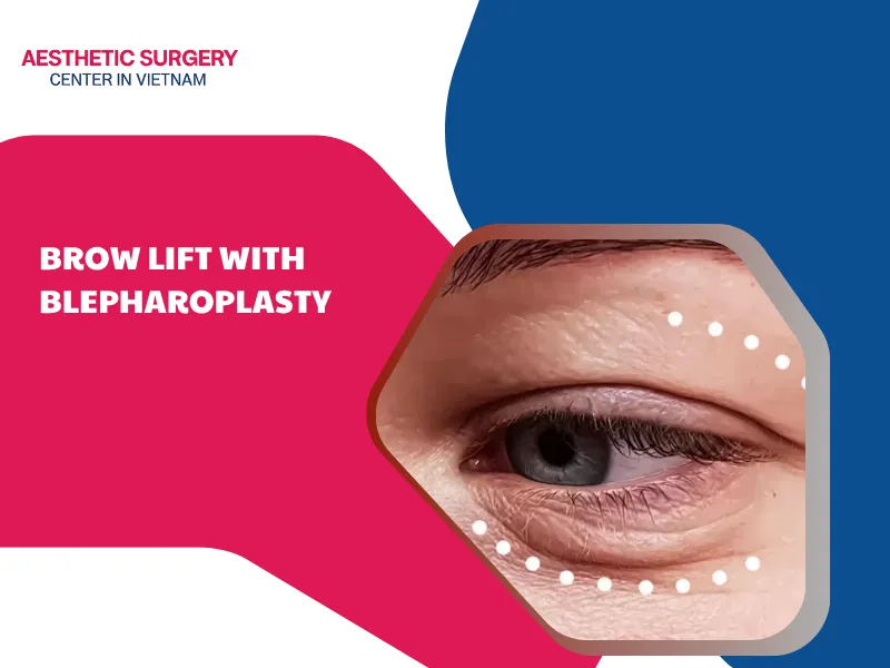 brow lift with blepharoplasty