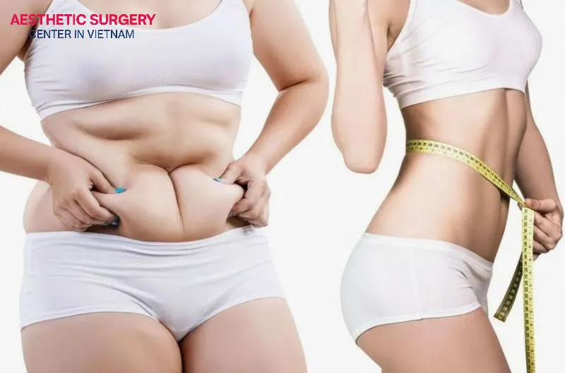 Liposuction is a procedure that removes stubborn fat deposits and helps refine body shape.