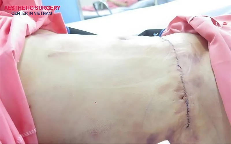 Some serious complications that may endanger patients during liposuction surgery