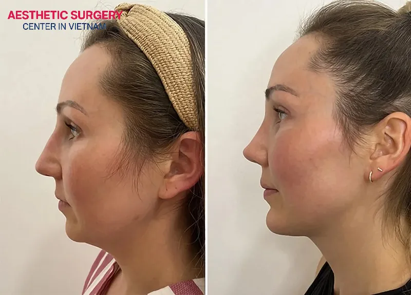 Close-up images of the client before and after rhinoplasty and chin augmentation.