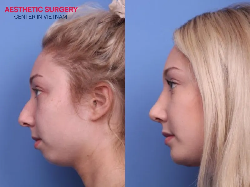 The woman’s appearance was completely transformed after chin augmentation and rhinoplasty.