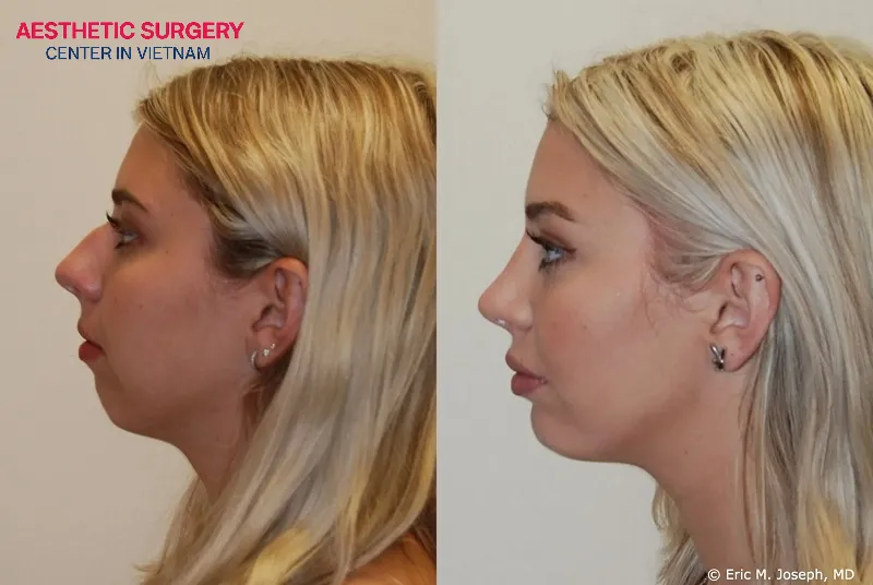 The woman successfully corrected her nose and chin imperfections, enhancing her overall beauty.