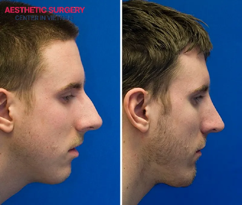 The young man’s appearance received a remarkable upgrade after undergoing combined chin augmentation and rhinoplasty.