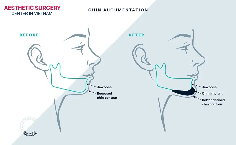 Chin augmentation is a cosmetic surgical procedure that corrects a receding or short chin, creating a beautiful chin shape that harmonizes with the face.