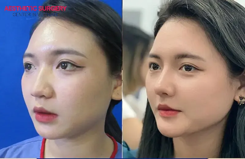 Chin augmentation and rhinoplasty can be performed at the same time to simultaneously correct imperfections in both the nose and chin.