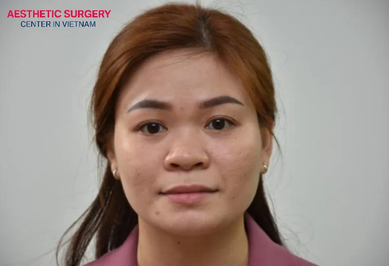 Individuals with both a flat nose and a receding chin can opt for the combined rhinoplasty and chin augmentation procedure to correct these imperfections.