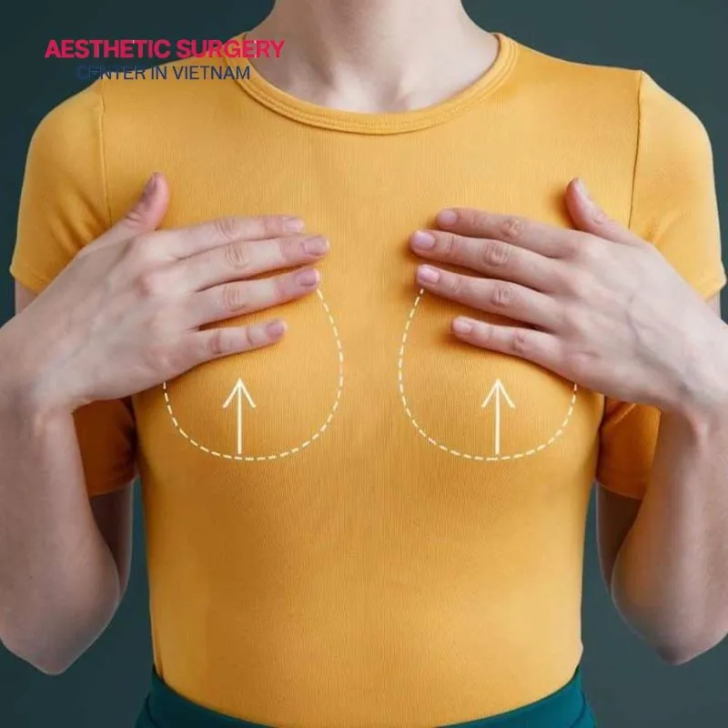 The breast lift procedure is suitable for those with sagging breasts caused by skin aging, childbirth, or significant weight loss.