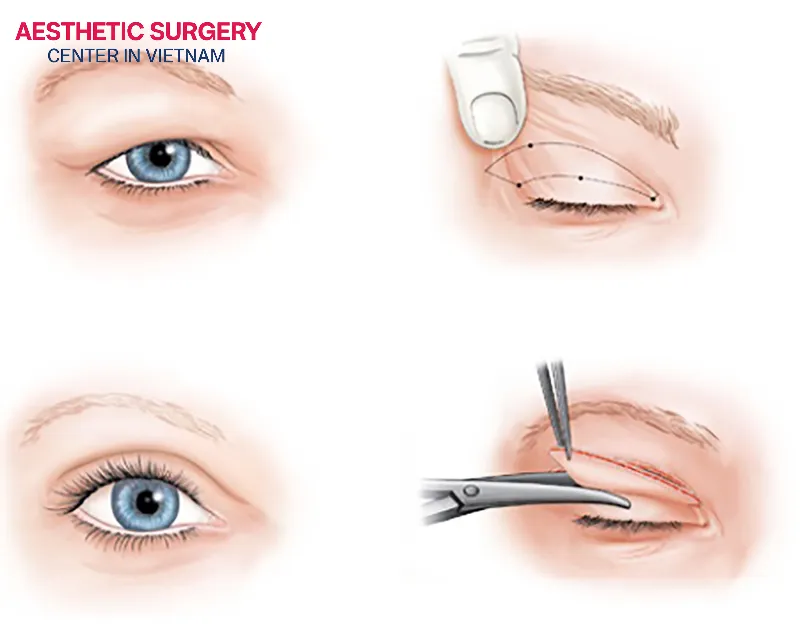 Double eyelid surgery is a minor cosmetic procedure designed to create a defined crease on the upper eyelid.