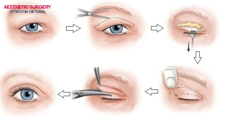 Double eyelid surgery using the incisional method, also known as eyelid crease cutting, helps create a beautiful crease with longer-lasting results.
