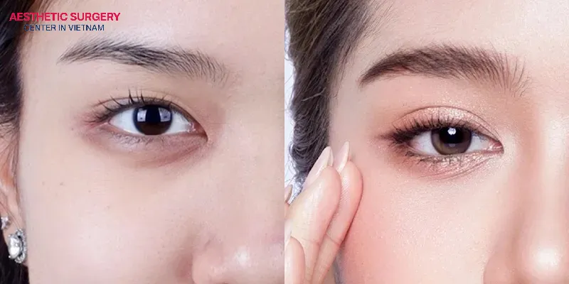 Double eyelid surgery helps create eyes that appear larger, more expressive, and with greater depth.