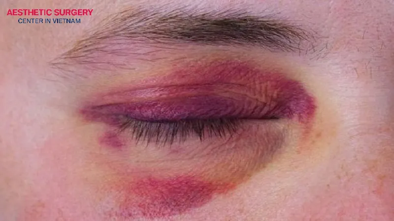After surgery, the area around the eyes may experience bruising, swelling, and discomfort.