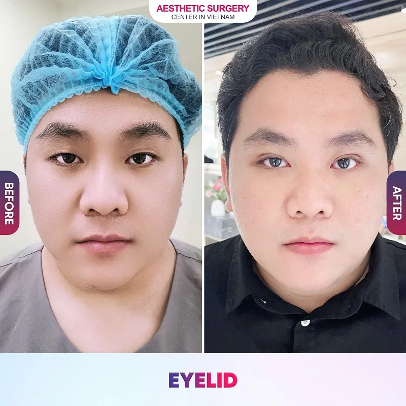 Images of clients before eyelid surgery at Aesthetic Surgery Vietnam.