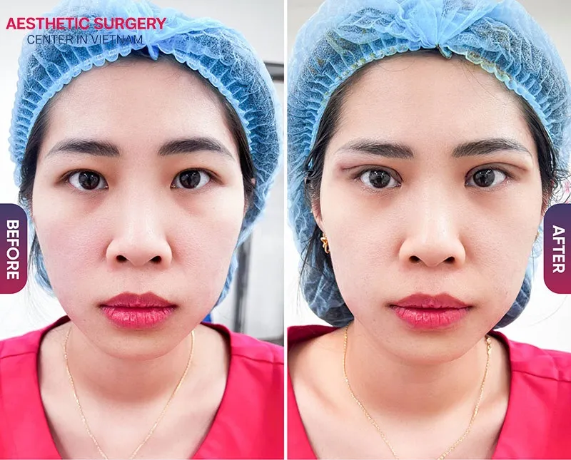 Eyelid surgery helps a woman look younger, more energetic, and better in terms of feng shui.