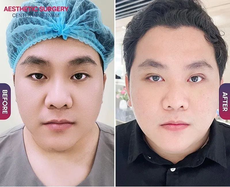 The young man looks much younger and more handsome after double eyelid surgery at Aesthetic Surgery Center.