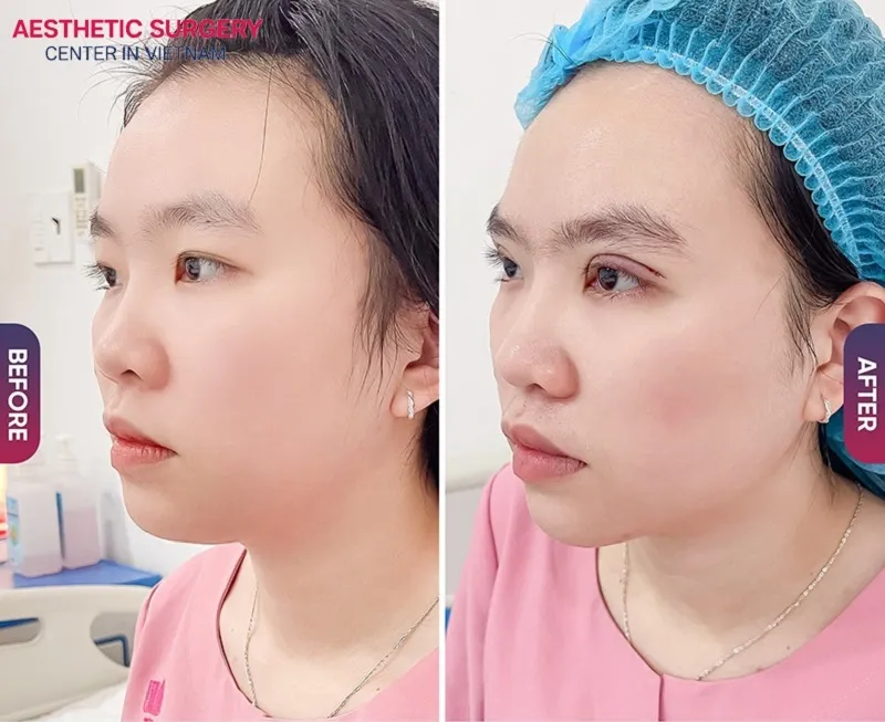 The client’s tapered eyelids have become clear double eyelids with even, beautiful creases, and once the eyelids settle into form, her eyes will look even more attractive.