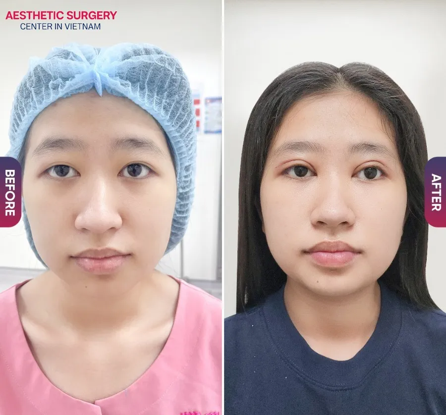 The woman now has beautiful double eyelids and a younger-looking face after eyelid surgery at Aesthetic Surgery Center.