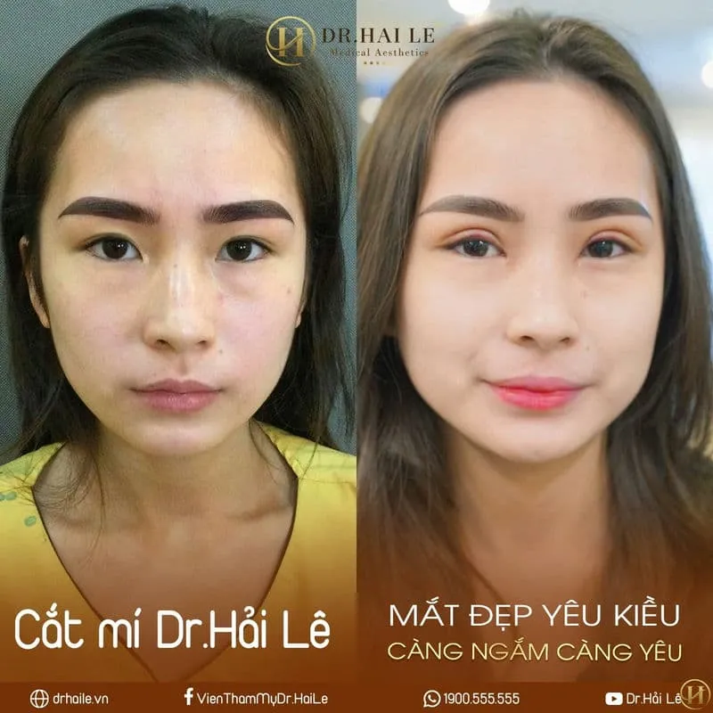 The woman’s appearance changed dramatically after eyelid surgery at Dr. Hai Le Medical Aesthetic Institute.