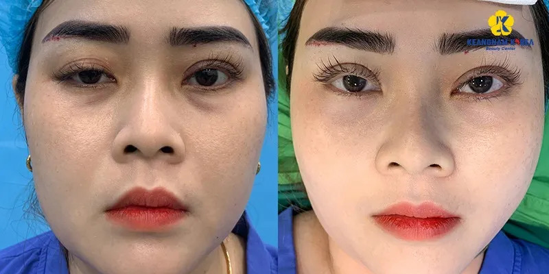 The eyes are more balanced on both sides, and the eyelid crease is more even and beautiful after eyelid surgery at Keangnam Korea Beauty Center.