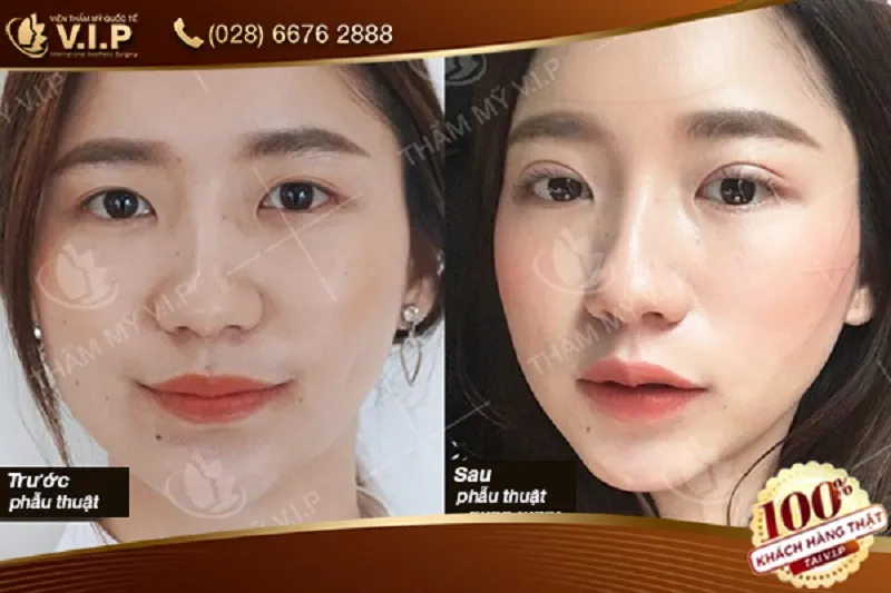 Before and after photos of clients’ eyelid surgery at VIP International Aesthetic Institute.