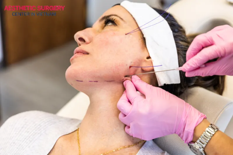 The traditional Facelift procedure can improve deep wrinkles, jawline definition, and neck sagging.