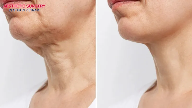 A neck lift typically involves an incision that extends from the earlobe to the hairline at the back.